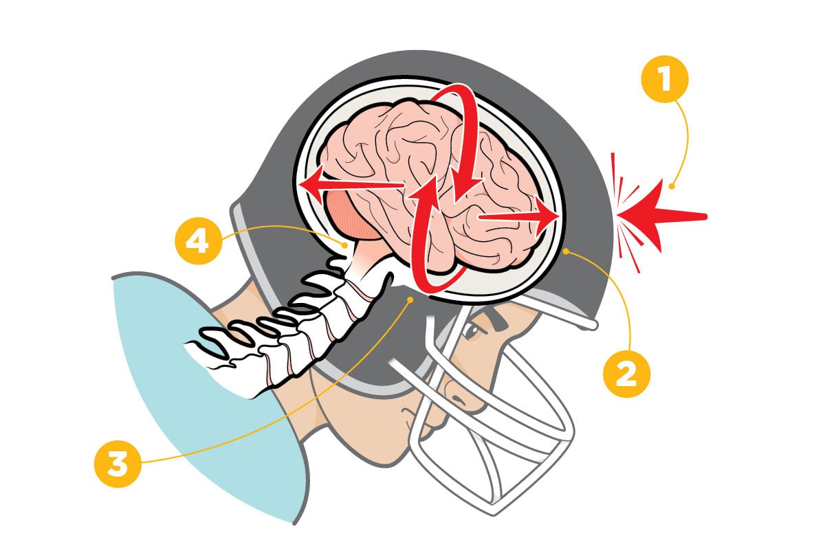 The NFL Is Using Sensor-Laden Mouthpieces to Study Concussions